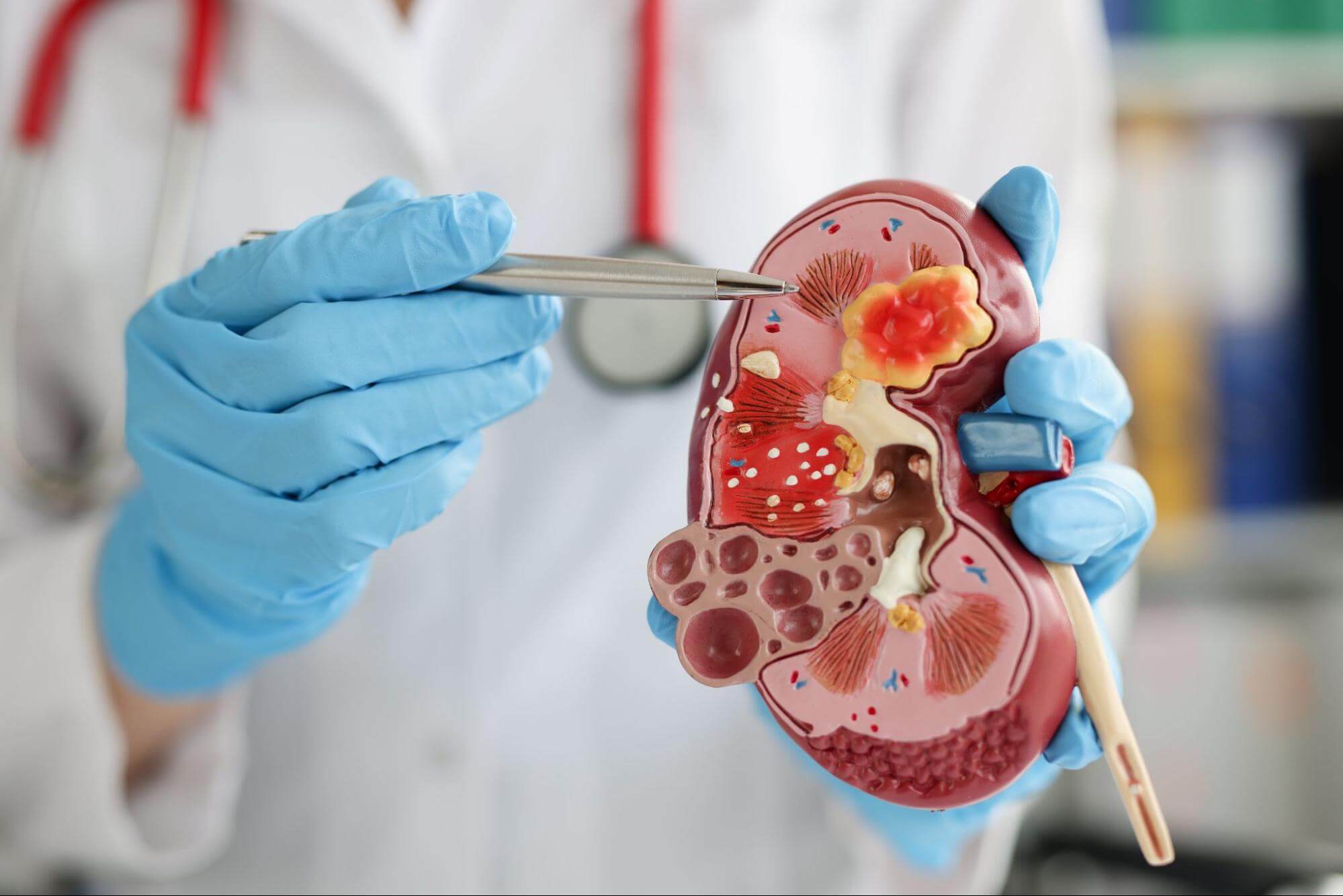 Kidney Stone Treatment West Palm Beach