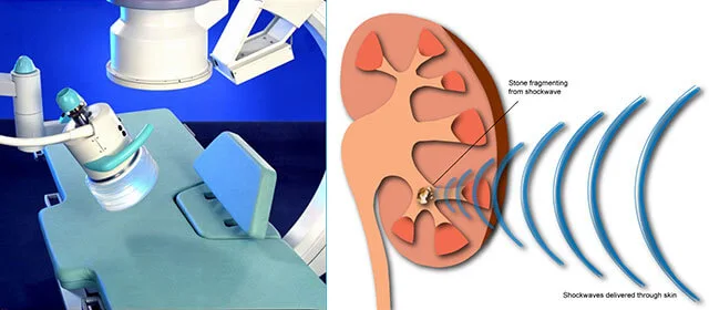 Lithotripsy Treatment West Palm Beach