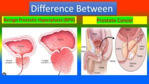 BPH vs. Prostate Cancer