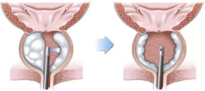 TURP vs GreenLight Laser Therapy