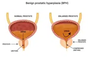 Understanding BPH and Its Symptoms