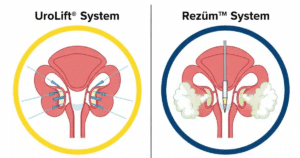 Urolift vs Rezum: The Better Minimally-Invasive BPH Option in 2025