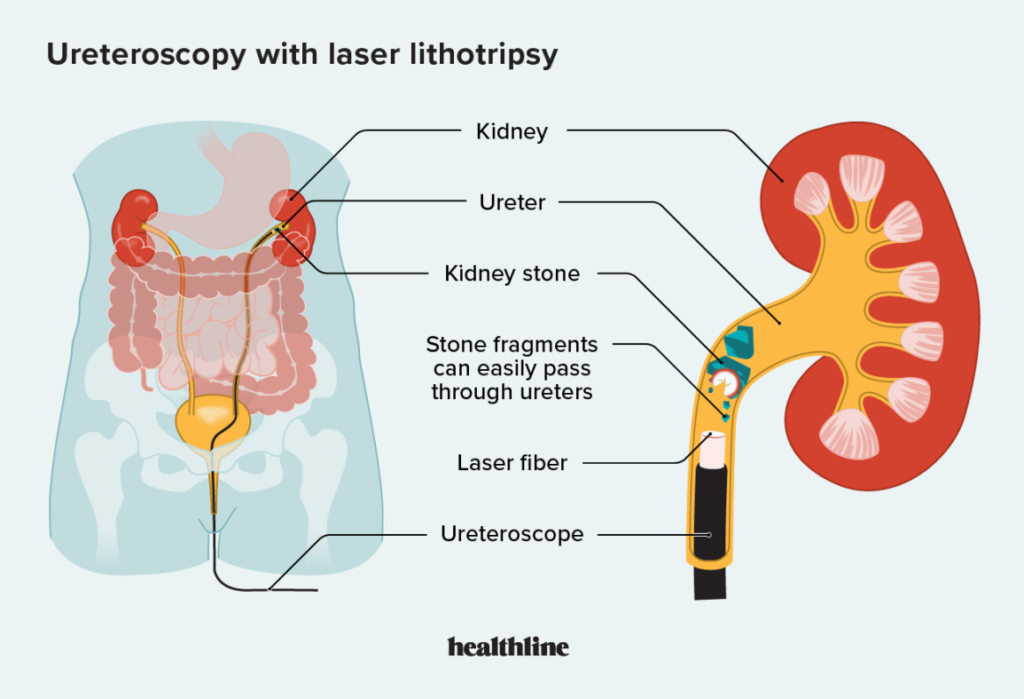 Shockwave Lithotripsy vs Laser Treatment for Kidney Stones