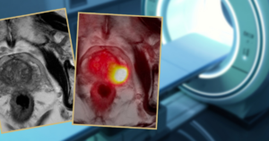 What Imaging Really Tells Us Before Prostate Cancer Surgery