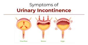 When Urinary Symptoms Are Not Caused by BPH