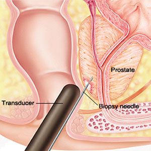Common Reasons Prostate Biopsies Miss Cancer