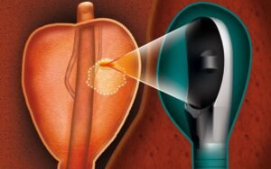 High-Intensity Focused Ultrasound (HIFU) Non-Invasive Prostate Cancer Ablation in West Palm Beach