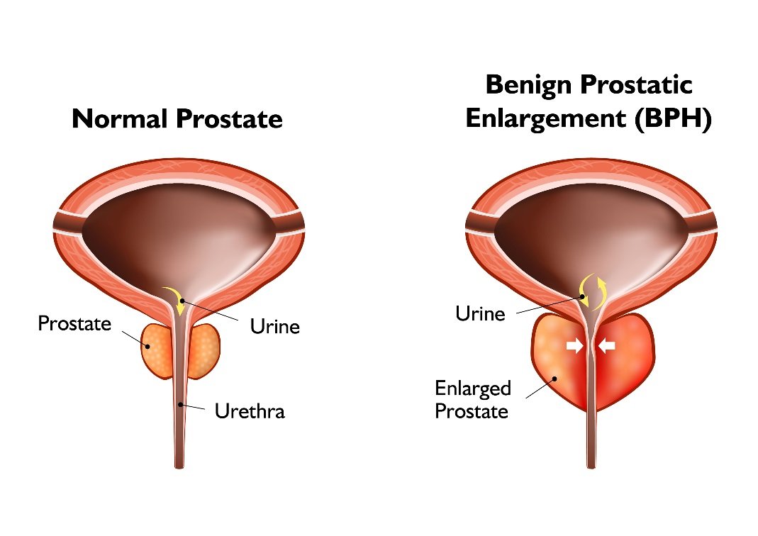 The UroLift System for Enlarged Prostate: Rapid Recovery Without