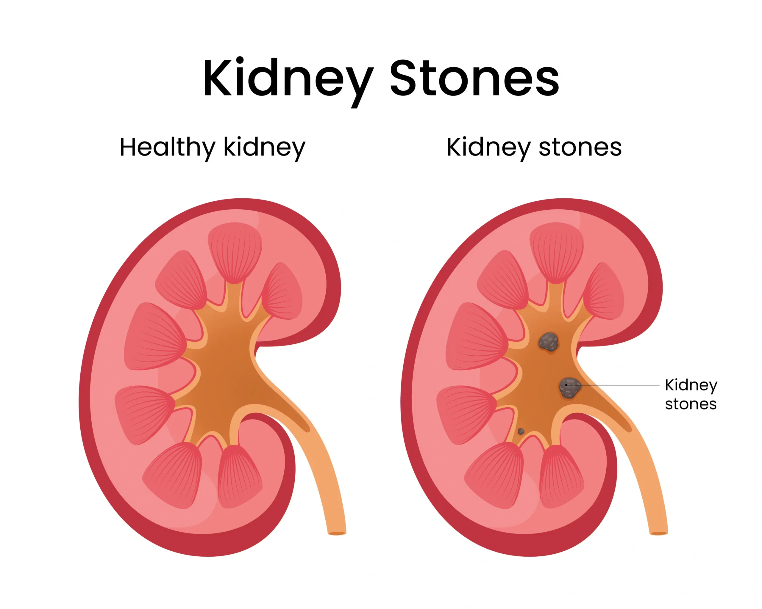 Complex Kidney Stone Relief