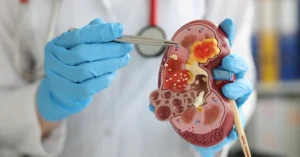 Complex Kidney Stone Relief