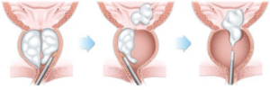 Holmium Laser Enucleation of the Prostate (HoLEP)