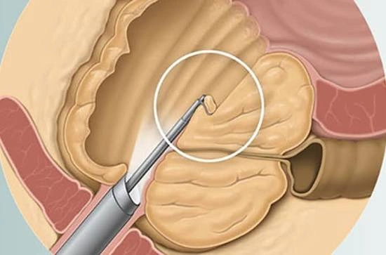 Holmium Laser Enucleation of the Prostate (HoLEP): The Gold Standard for Massive BPH and Large Prostate Volumes Holmium Laser Enucleation of the Prostate (HoLEP)