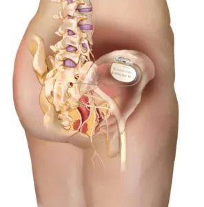 Managing Overactive Bladder (OAB) and Refractory Urgency: From Sacral Neuromodulation (InterStim/Axonics) to Botox Injection Therapy