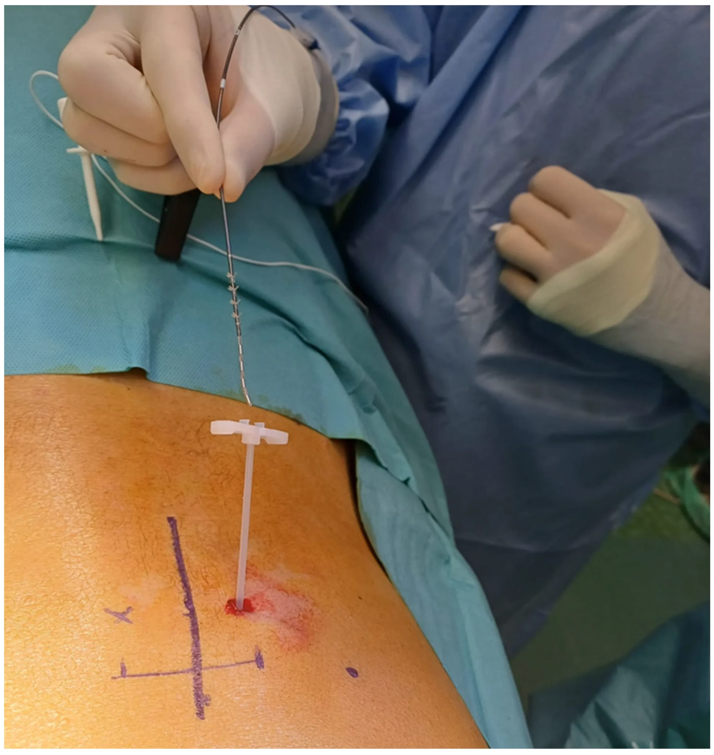 Overactive Bladder
