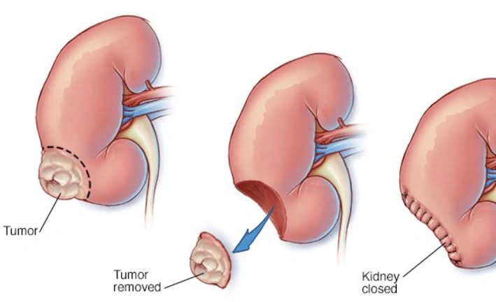 Robotic Partial Nephrectomy