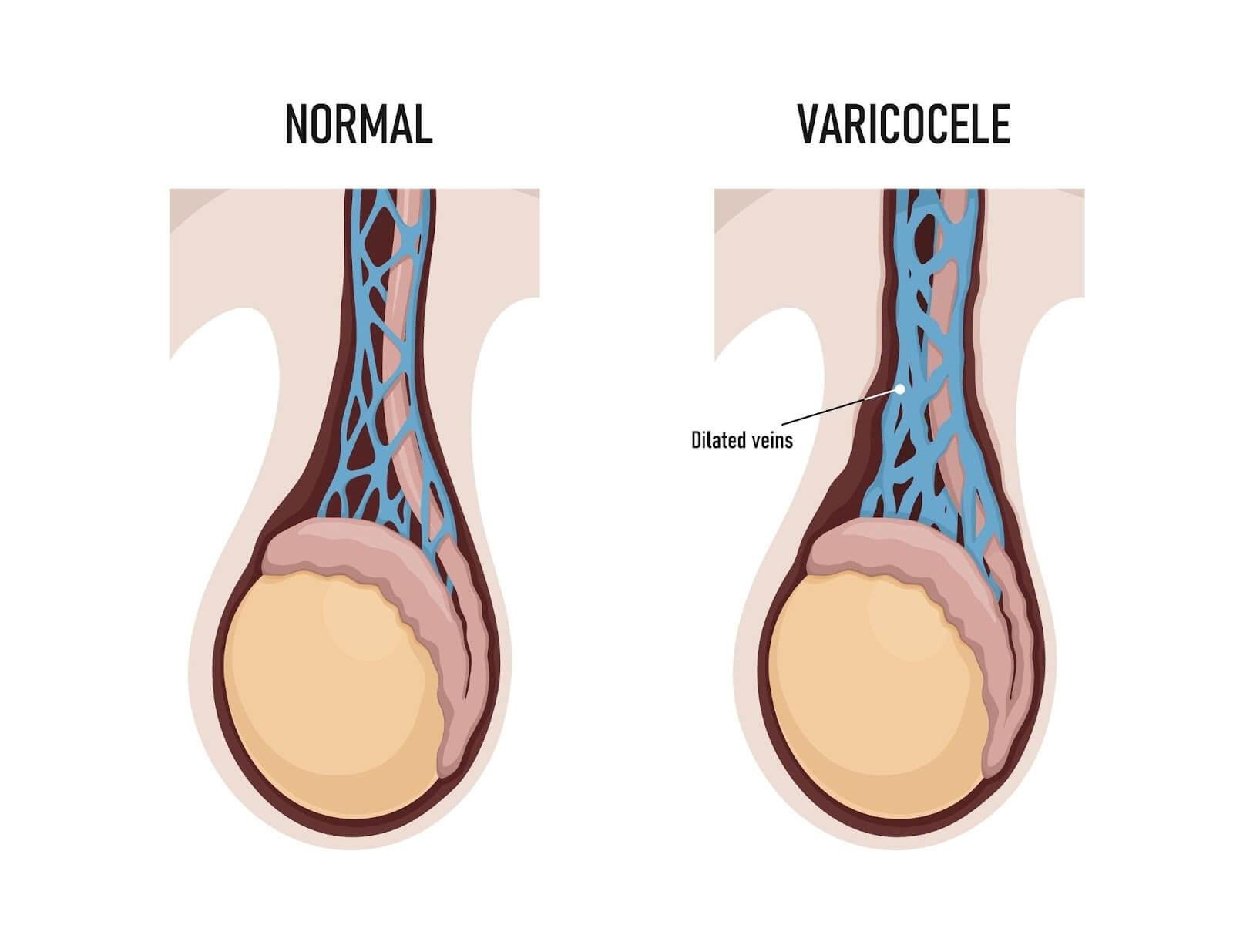 Testicular Pain, Masses, and Men's Health: Evidence-Based Diagnostic Frameworks for Scrotal and Testicular Pathology Testicular Pain, Masses, and Men's Health: Evidence-Based Diagnostic Frameworks for Scrotal and Testicular Pathology