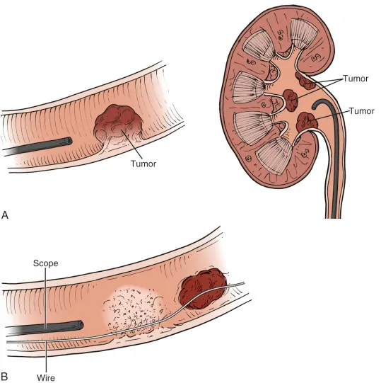 Endoscopic Management of Upper Tract Urothelial Carcinoma