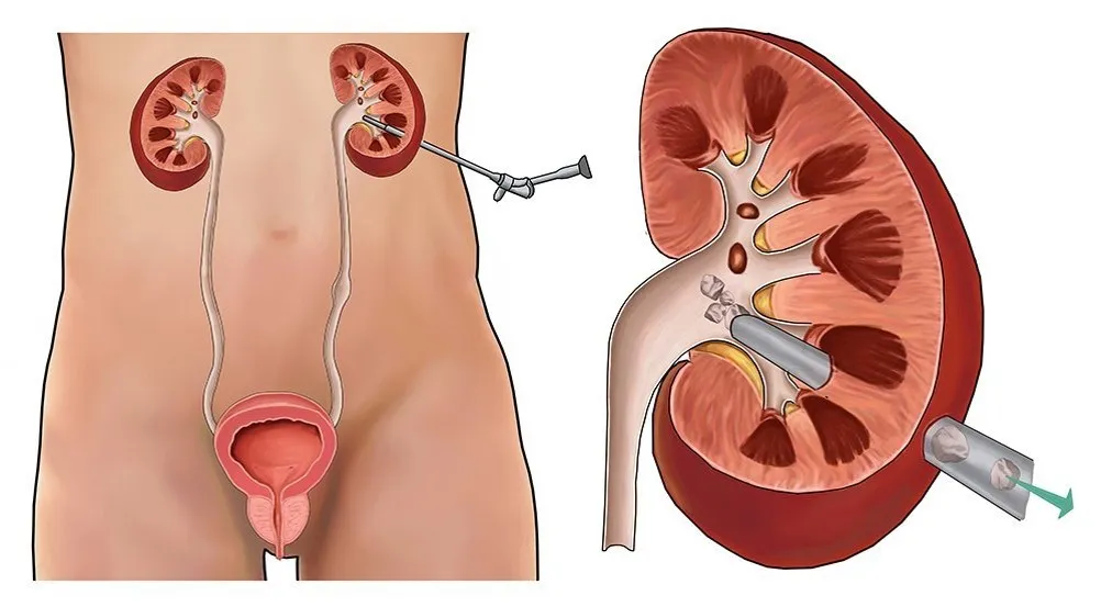 Comprehensive Kidney Stone Management: From Shock Wave Lithotripsy to Percutaneous Nephrolithotomy (PCNL)