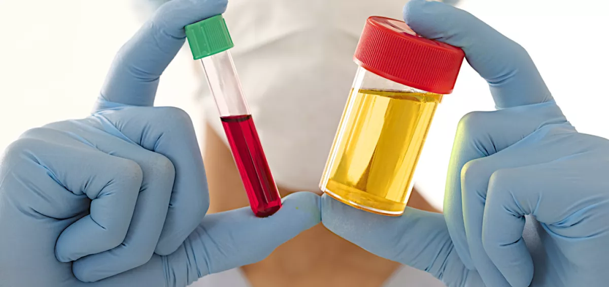 Evaluating Hematuria (Blood in Urine): Comprehensive Workup Protocols for Early Bladder and Kidney Cancer Detection Evaluating Hematuria (Blood in Urine): Comprehensive Workup Protocols for Early Bladder and Kidney Cancer Detection