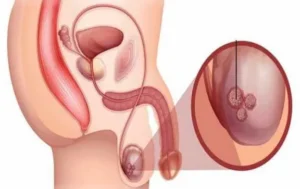 Male Endocrine and Scrotal Health: Diagnostic Approaches to Hypogonadism, Hydroceles, and Testicular Masses