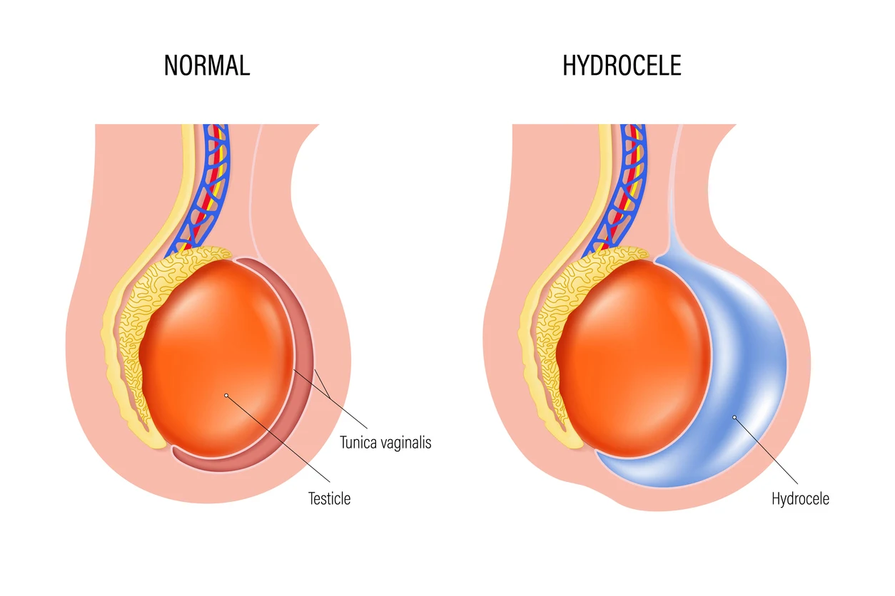 Male Endocrine and Scrotal Health: Diagnostic Approaches to Hypogonadism, Hydroceles, and Testicular Masses