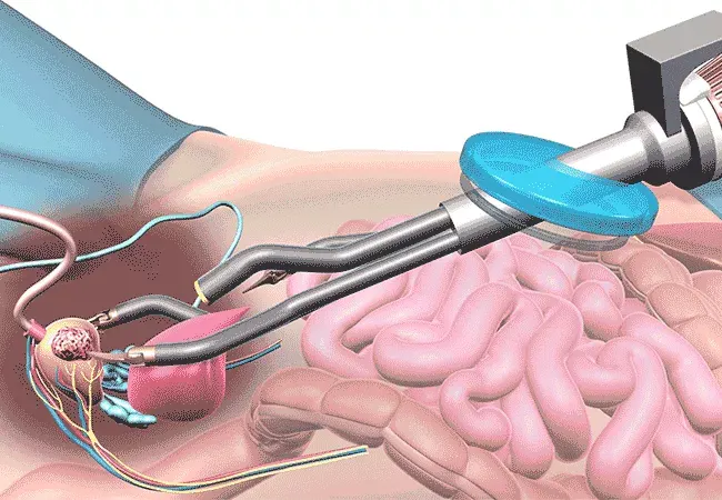 Robotic-Assisted Radical Prostatectomy