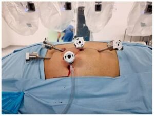 Robotic Nephron-Sparing Partial Nephrectomy: Preserving Renal Function in Complex Renal Tumors