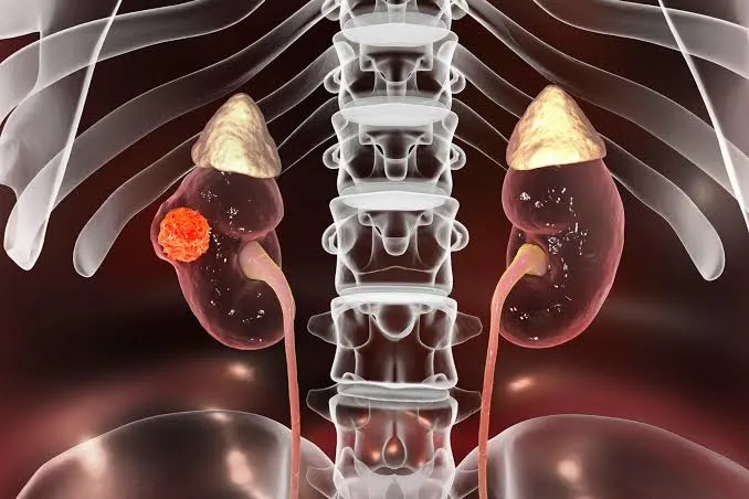 Robotic Nephron-Sparing Partial Nephrectomy