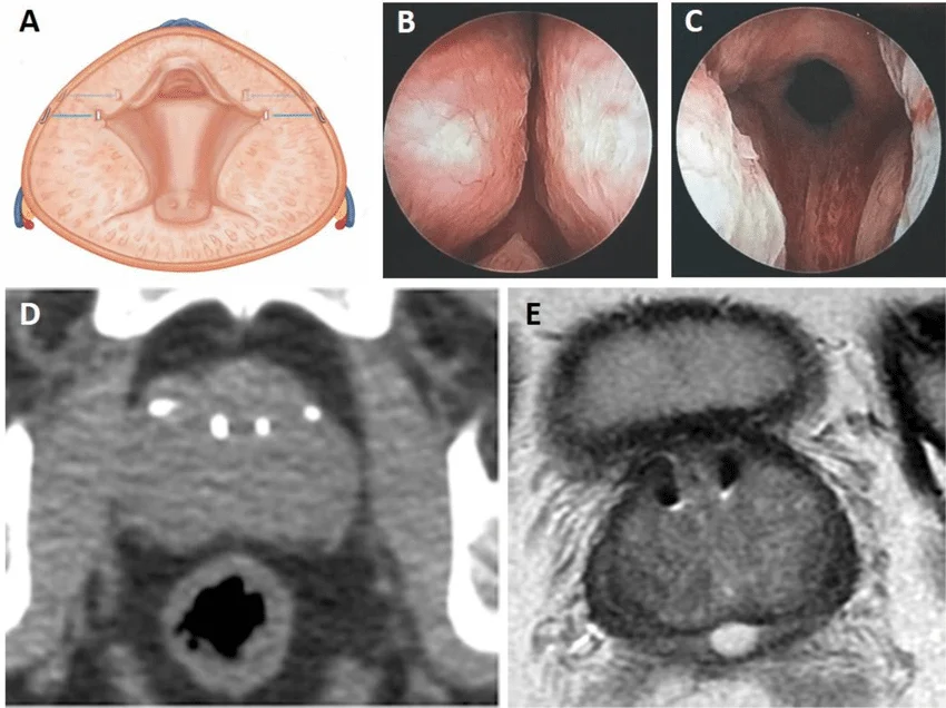 Minimally Invasive BPH Relief: Comparing UroLift® Implants to Traditional TURP UroLift vs TURP